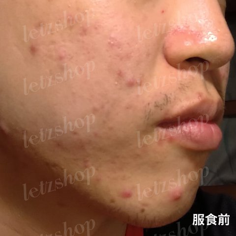 暗瘡解決方法｜去暗瘡食Onecare Praventac用家實測！2個月減瘡印/消炎達70%