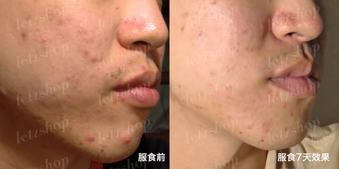 暗瘡解決方法｜去暗瘡食Onecare Praventac用家實測！2個月減瘡印/消炎達70%