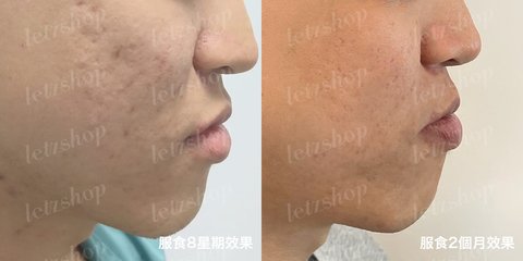 暗瘡解決方法｜去暗瘡食Onecare Praventac用家實測！2個月減瘡印/消炎達70%