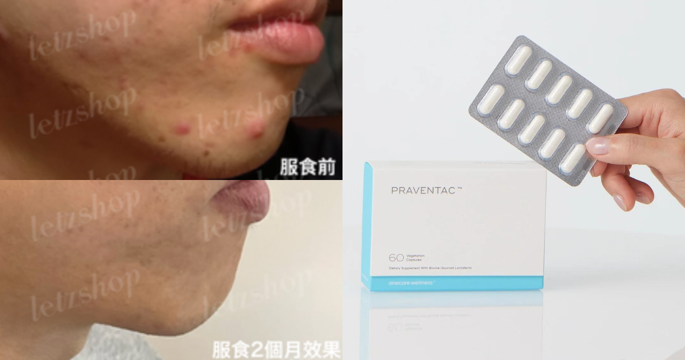暗瘡解決方法｜去暗瘡食Onecare Praventac用家實測！2個月減瘡印/消炎達70%
