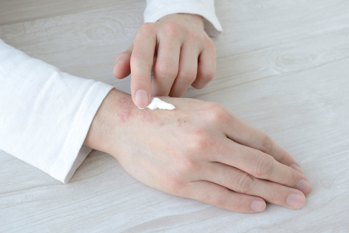 濕疹藥膏推薦｜濕疹原因+濕疹止癢方法！凡士林能舒緩？敏感肌護膚品推薦