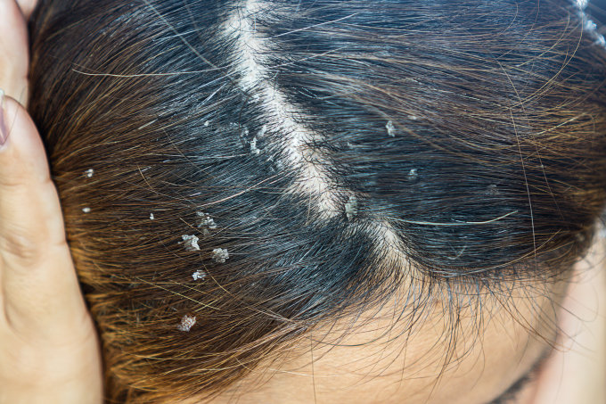 頭皮濕疹洗頭水推薦｜頭皮濕疹症狀+原因！10款濕疹都用得的防脫髮洗頭水是？