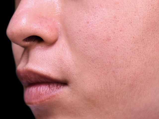 毛孔粗大原因｜毛孔粗大怎麼辦？中醫角度分析毛孔粗大類型+收毛孔方法【專欄】