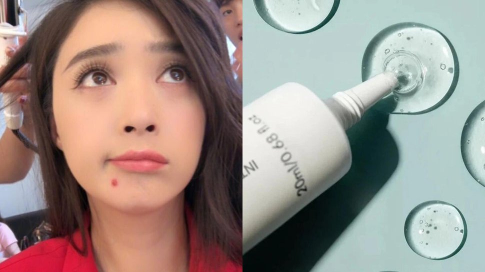 6個下巴暗瘡解決方法！拆解下巴暗瘡成因及改善方法+10款去暗瘡產品推薦