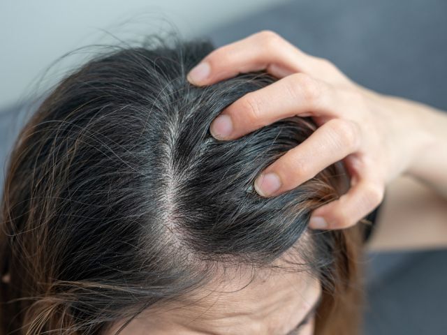 13 款去頭皮洗頭水推薦｜頭皮屑大片原因？6個頭皮屑改善方法+好用去屑洗頭水介紹