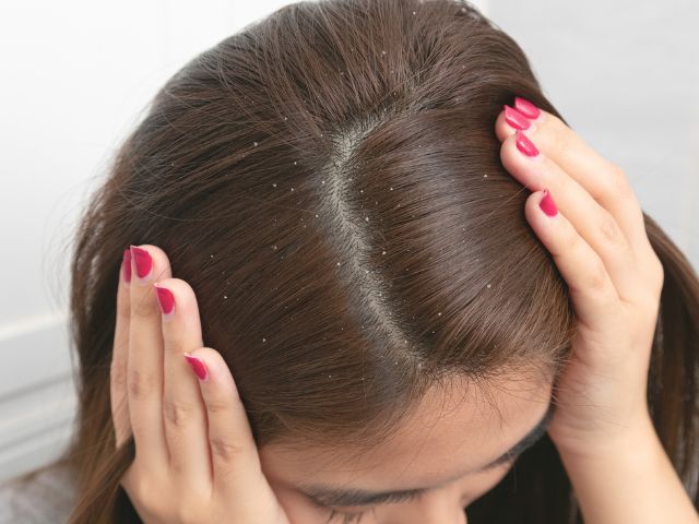 13 款去頭皮洗頭水推薦｜頭皮屑大片原因？6個頭皮屑改善方法+好用去屑洗頭水介紹